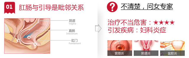 肛肠疾病引发妇科炎症